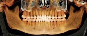 Anatomage X-ray of Human Jaw Showing Teeth