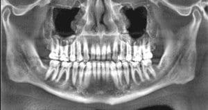 X-ray of Human Jaw Showing Teeth