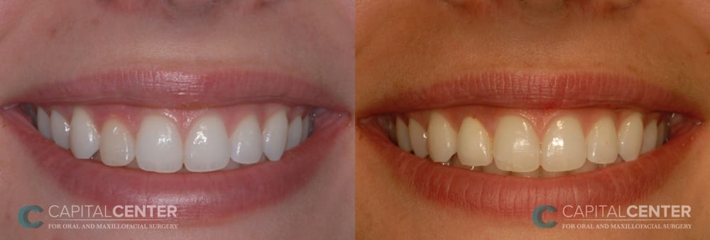 Patient 1 Oral Surgery Before and After Right Lateral Incisor