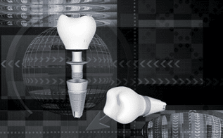 Capitol Center® - What Can I Do About My Loose Dental Implant?