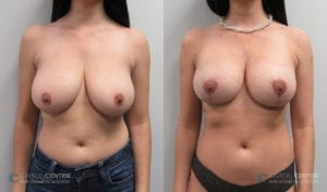 Patient 9 Breast Lift and Augmentation Before and After Front View