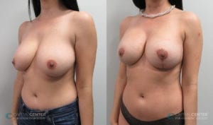 Patient 9 Breast Lift and Augmentation Before and After Oblique View