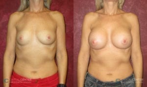Patient 2 Breast Augmentation Before and After Front View