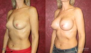 Patient 2 Breast Augmentation Before and After Oblique View
