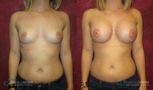 Patient 3 Breast Augmentation Before and After Front View