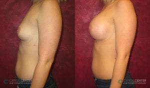 Patient 3 Breast Augmentation Before and After Side View
