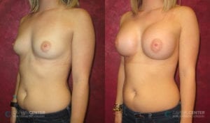 Patient 3 Breast Augmentation Before and After Oblique View
