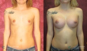 Patient 4 Breast Augmentation Before and After Front View