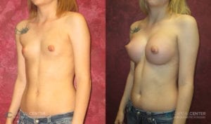 Patient 4 Breast Augmentation Before and After Oblique View