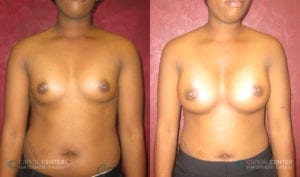 Patient 5 Breast Augmentation Before and After Front View