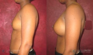 Patient 5 Breast Augmentation Before and After Side View