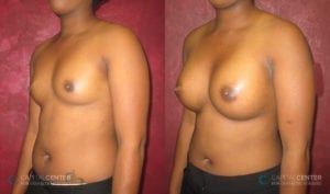 Patient 5 Breast Augmentation Before and After Oblique View