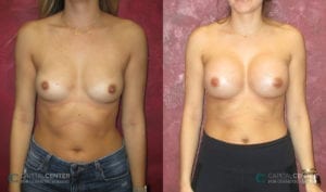 Patient 6 Breast Augmentation Before and After Front View