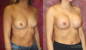 Patient 6 Breast Augmentation Before and After Oblique View