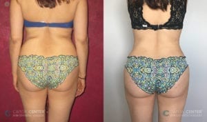 Patient 10 Lipo and BBL Before and After Back View
