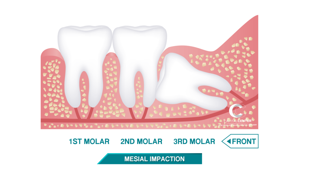 Wisdom Teeth Removal in Washignton D.C. | CCOMFS