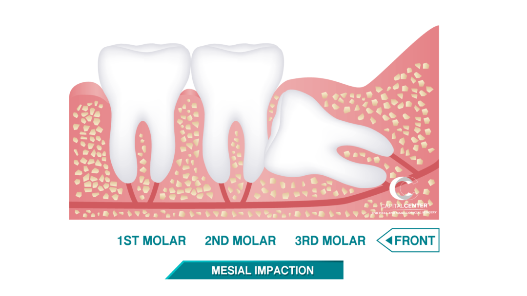 Wisdom Teeth Removal in Washignton D.C. | CCOMFS