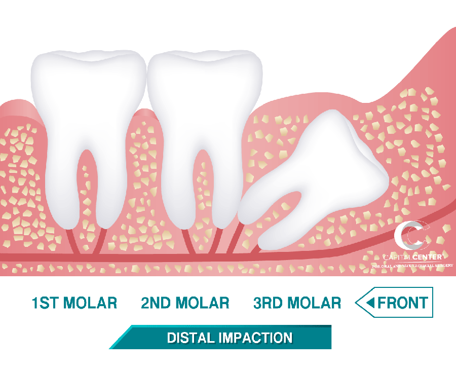 Distal Impaction