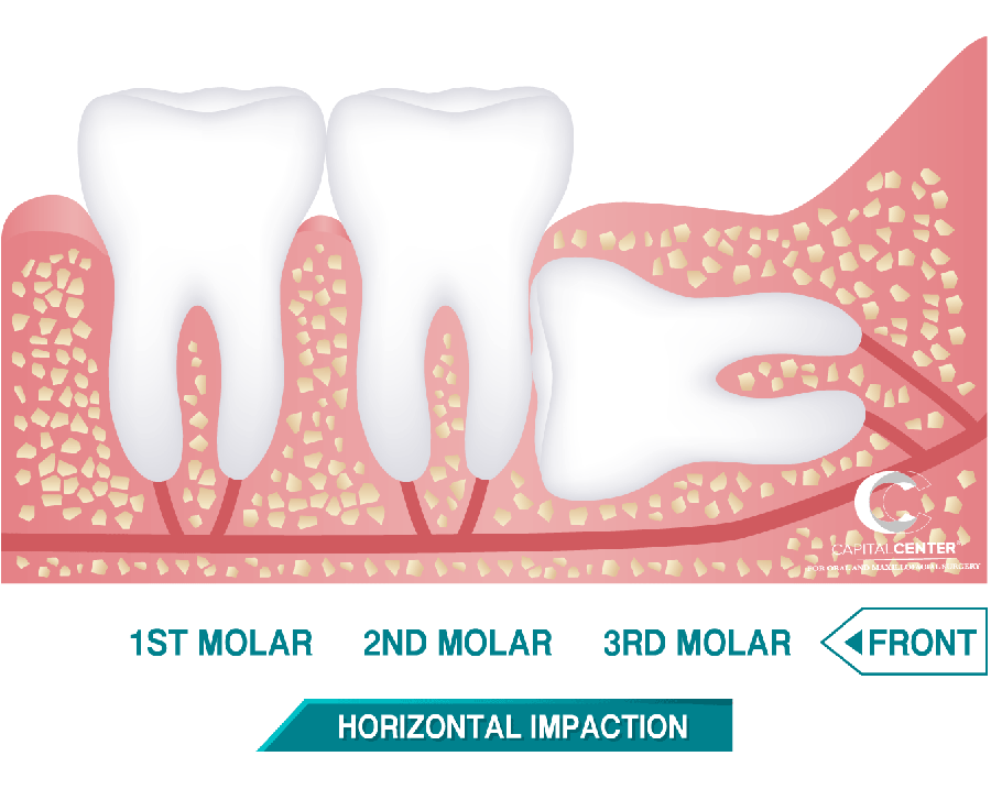 Horizontal Impaction