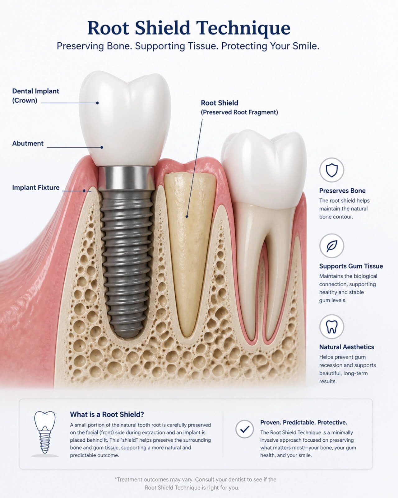  A clinical visualization of the Root Shield technique, showing a preserved natural root fragment protecting the surrounding bone and gum tissue during implant placement.