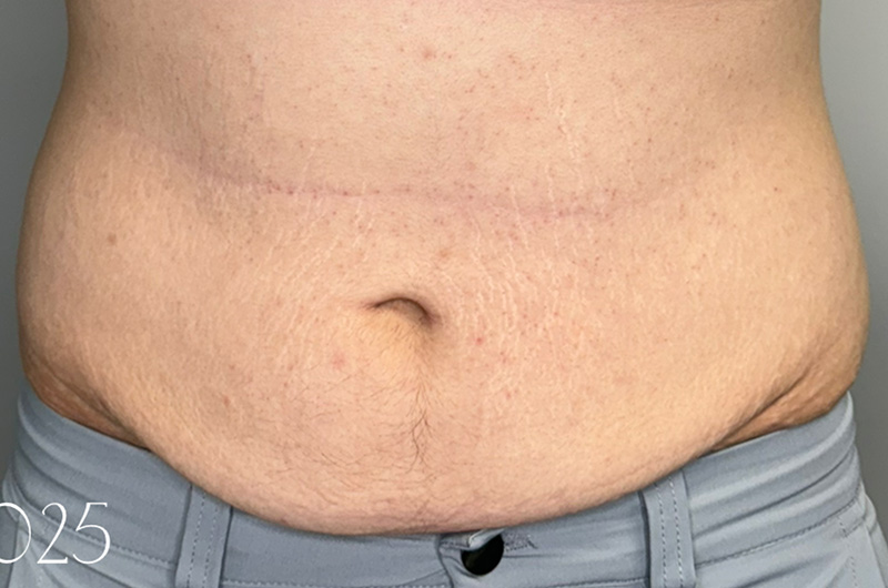 Case--9592 | Before Morpheus 8 1