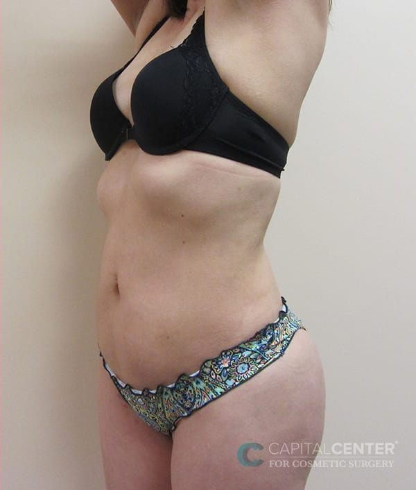 Case--6577 | After Body 2