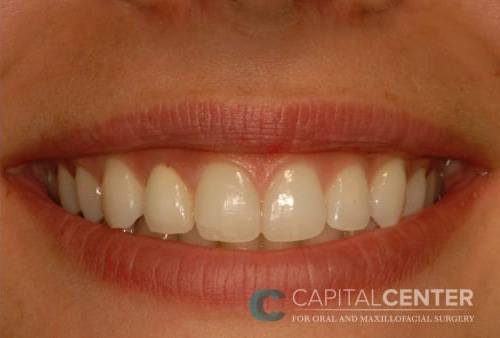 Case--3634 | After Oral 1