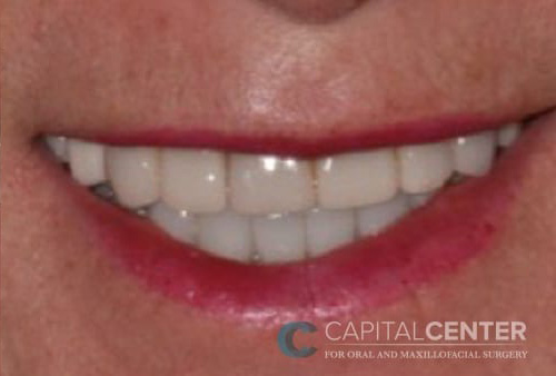 Case--1314 | After Oral 1