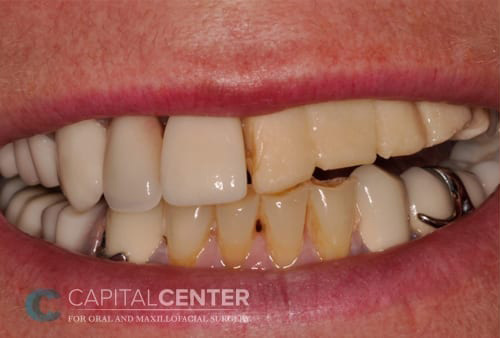 Case--1314 | Before Oral 1