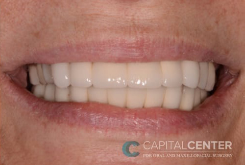 Case--7390 | After Oral 1