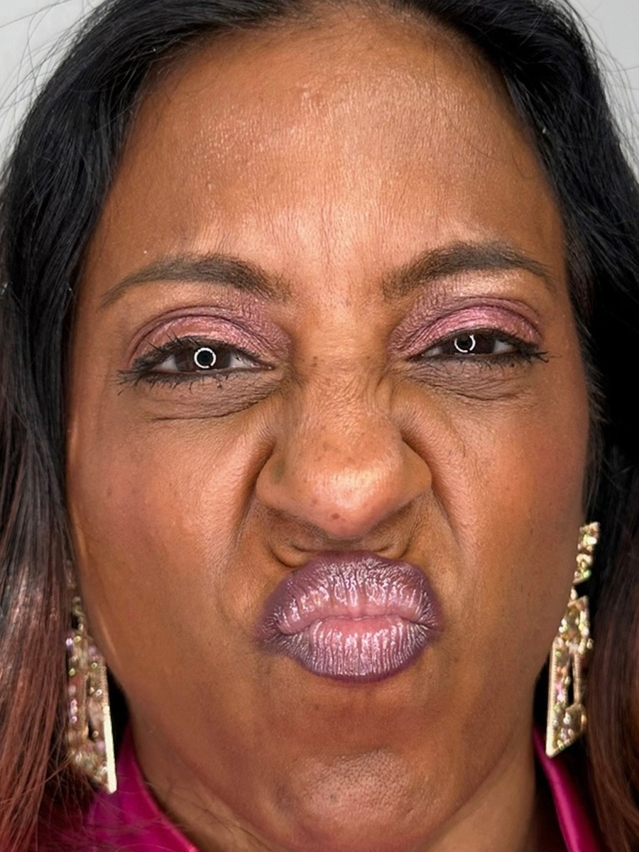 Case--5335 | After BOTOX® Cosmetic 2