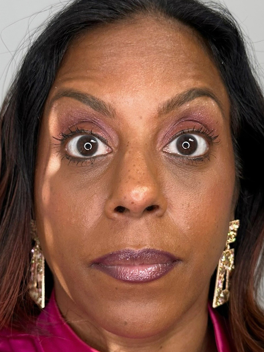 Case--5335 | After BOTOX® Cosmetic 3