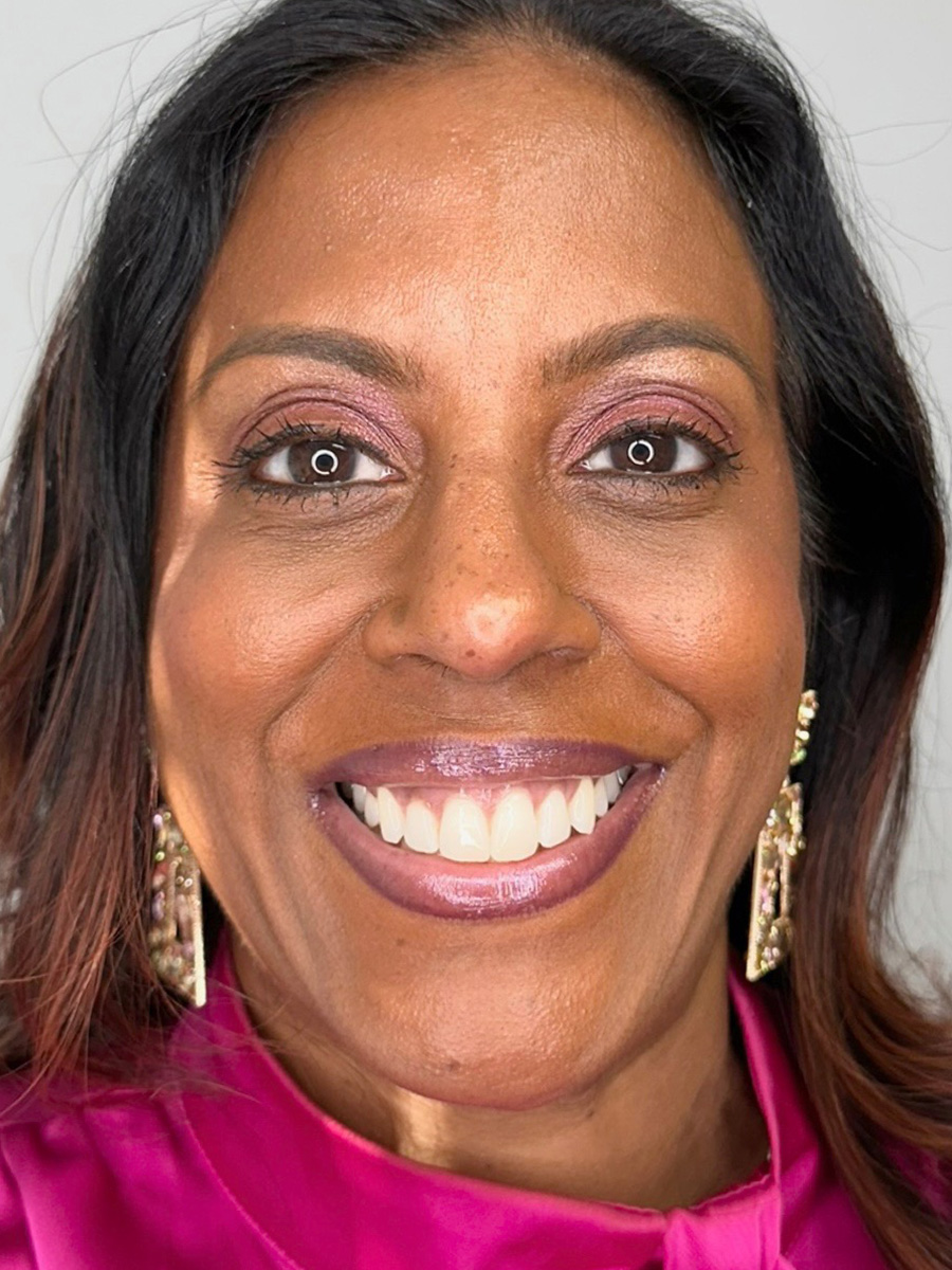 Case--5335 | After BOTOX® Cosmetic 1