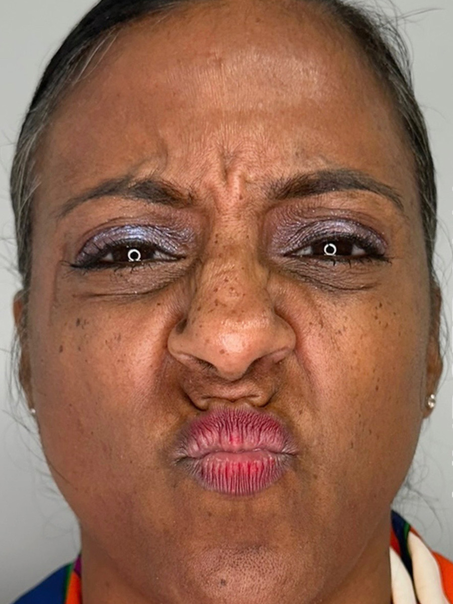 Case--5335 | Before BOTOX® Cosmetic 2