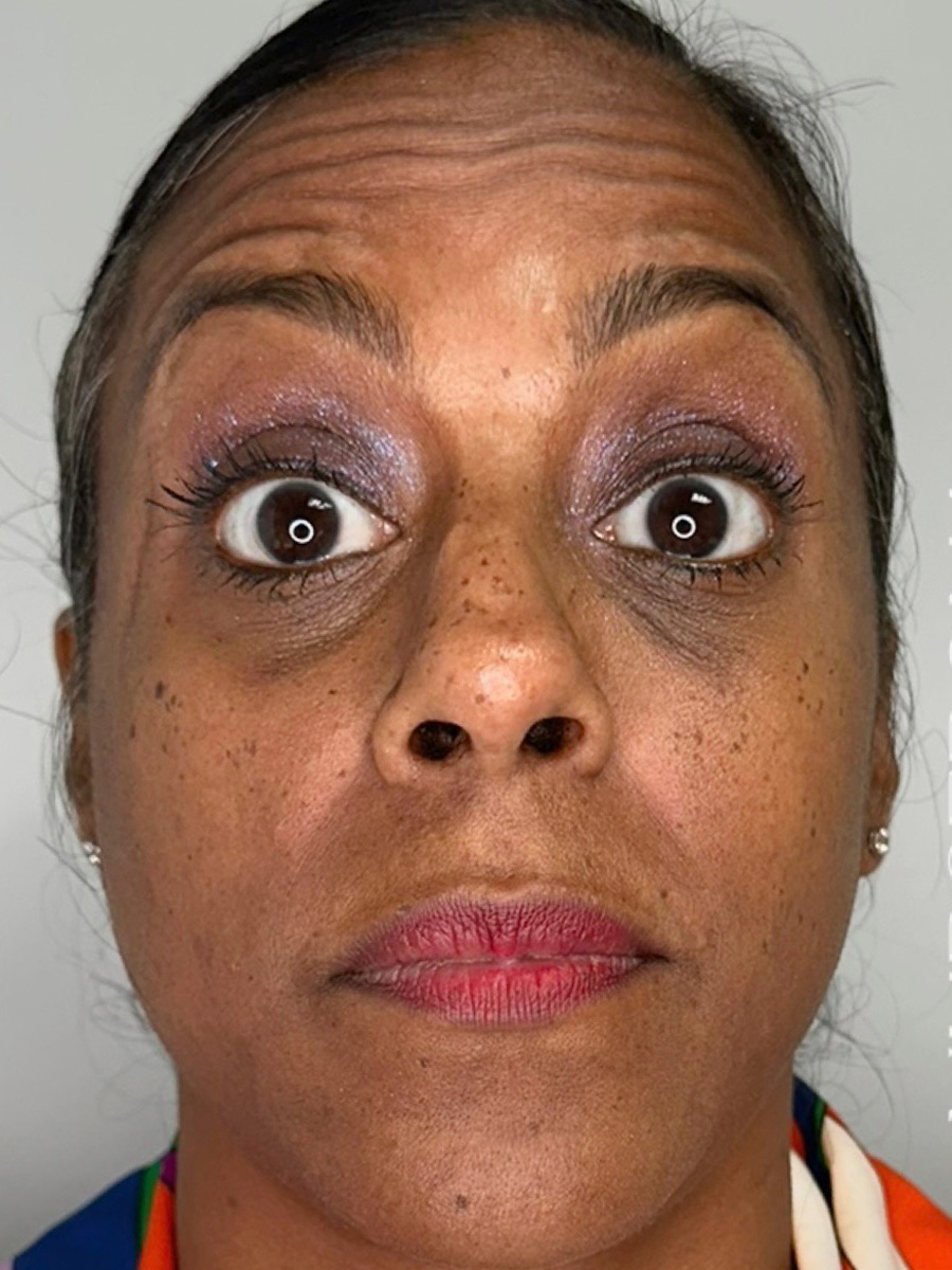 Case--5335 | Before BOTOX® Cosmetic 3