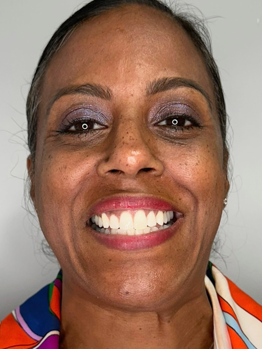 Case--5335 | Before BOTOX® Cosmetic 1