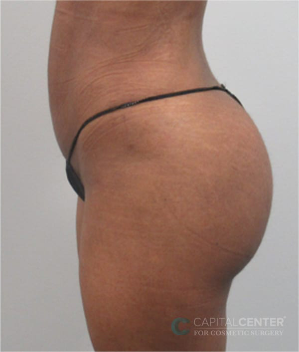 Case--3085 | After Body 2