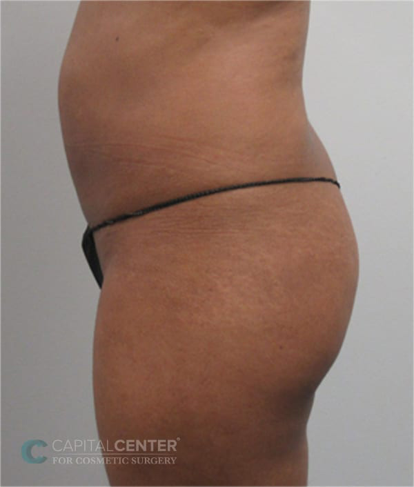 Case--3085 | Before Body 2