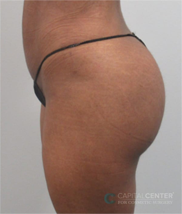 Case--3085 | After Body 3