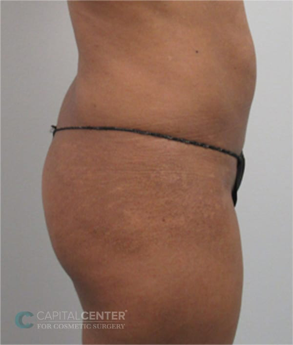 Case--3085 | Before Body 3