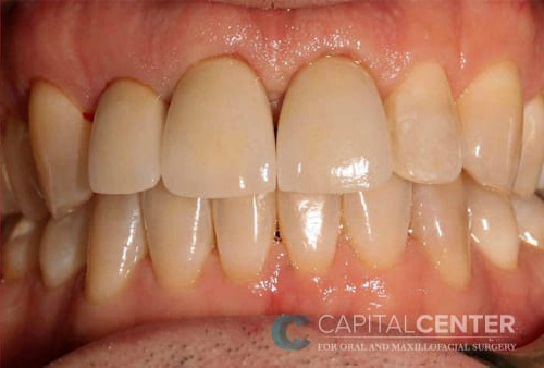 Case--8675 | After Oral 1