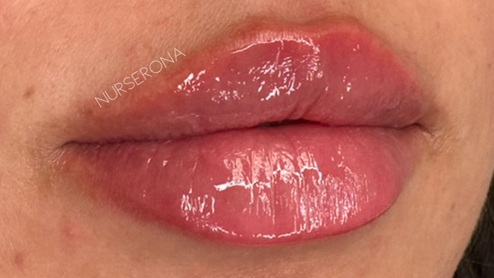 Case--4779 | After Lip Filler 1