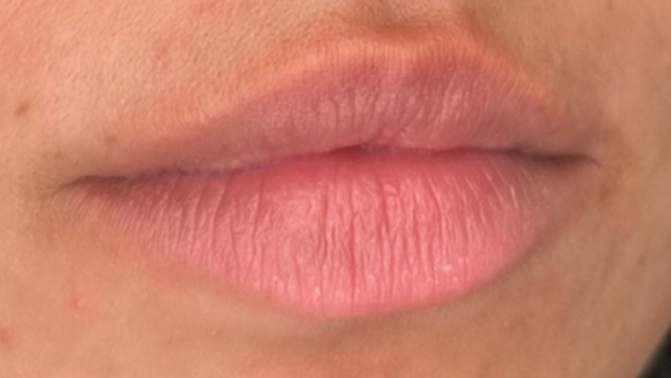 Case--4779 | Before Lip Filler 1