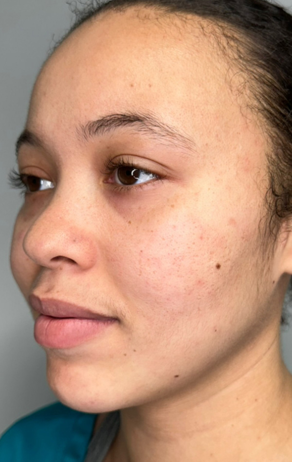 Case--5719 | After Microneedling 1