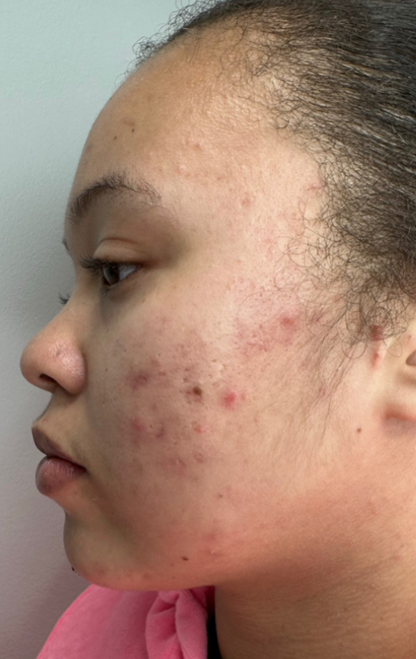 Case--5719 | Before Microneedling 1